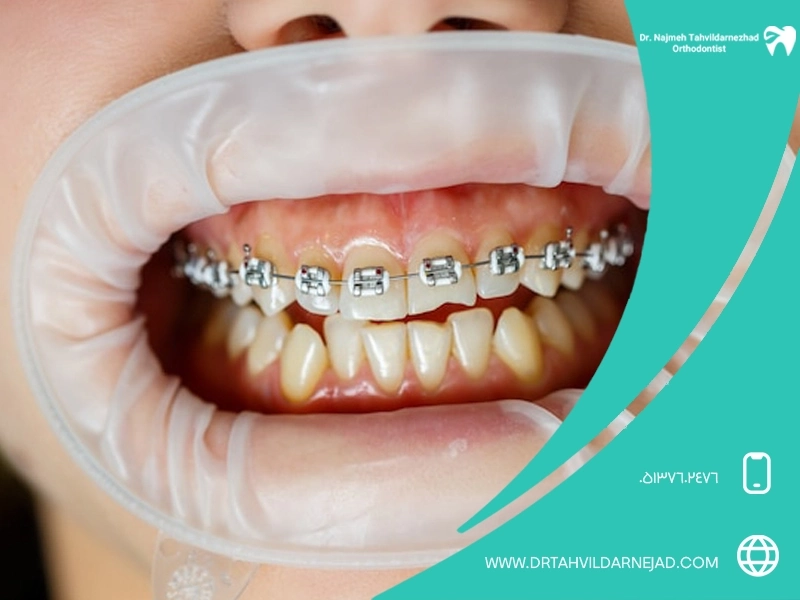 دراسة تأثير تقويم الأسنان على تحسين نوعية النوم د. نجمة تدردار نجاد