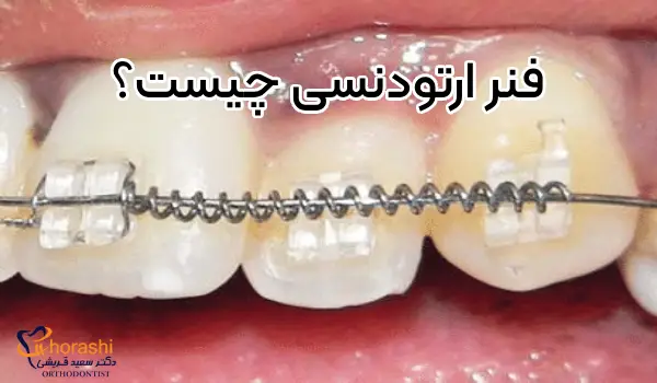 کویل اسپرینگ یا فنر ارتودنسی چیست؟ | دکتر سعید قریشی