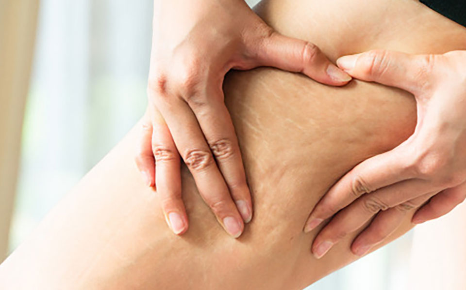 بهترین درمان سلولیت و پوست پرتقال با دستگاه پوست در زعفرانیه; لاغری و سفت کننده همزمان با دکتر ویدا شکیبا - کلینیک زیبایی دکتر ویدا شکیبا زعفرانیه و صادقیه تهران