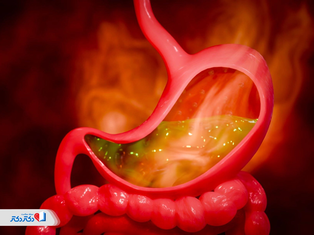 کاهش فوری و خانگی اسید معده (برای بارداری و رفلاکس)