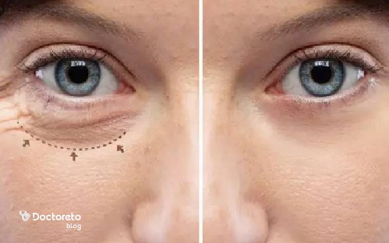 روش های انجام عمل پف زیر چشم و مزایا و معایب آن