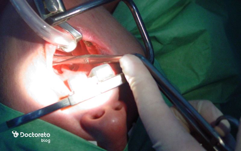 برداشتن لوزه سوم: نکات مراقبتی و عوارض بعد از آن