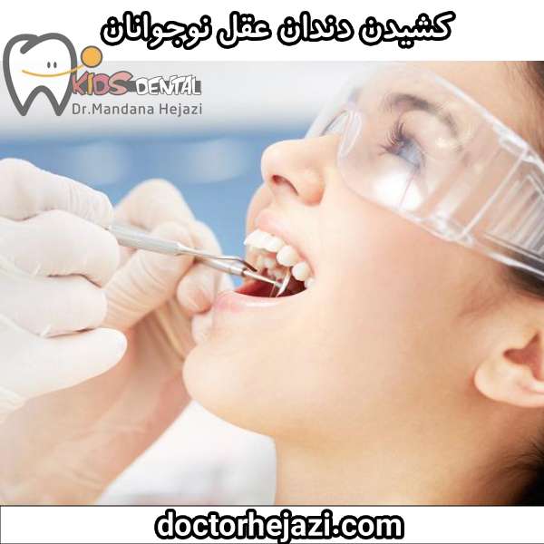 کشیدن دندان عقل نوجوانان دکتر ماندانا حجازی
