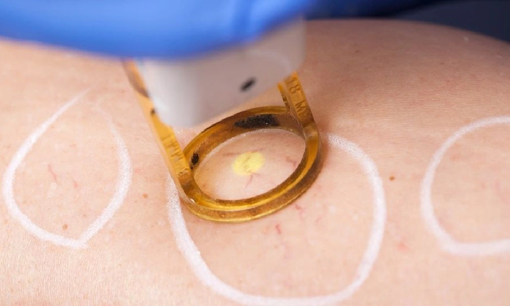 درمان واریس با لیزر؛ با واریس خداحافظی کنید