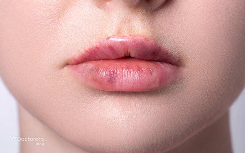 کبودی لب و هر آنچه که باید در مورد علل آن بدانید