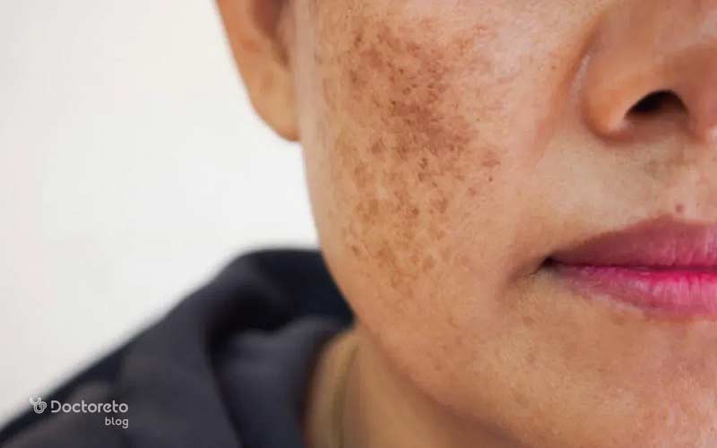 لکه بارداری ملاسما از علل تا روش های درمان آن