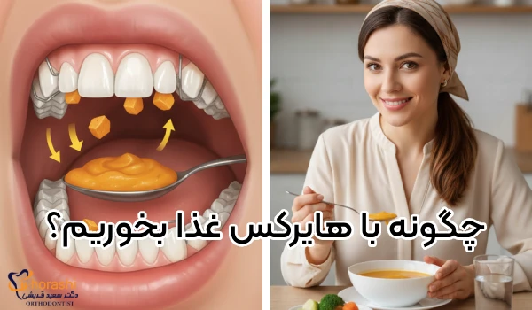 چگونه با دستگاه ارتودنسی هایرکس غذا بخوریم؟