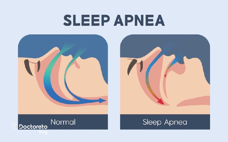 آپنه خواب یا آپنه انسدادی خواب چیست و چگونه درمان می شود؟