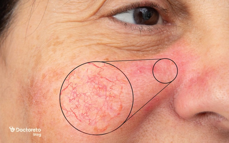 علت پیدایش وریدهای عنکبوتی و روش درمان آن