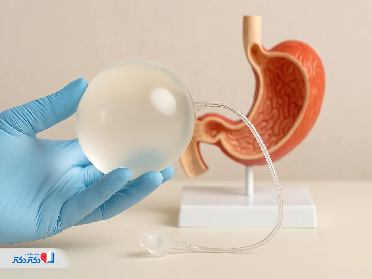 Gastric balloon Benefits, complications and costs of 1404