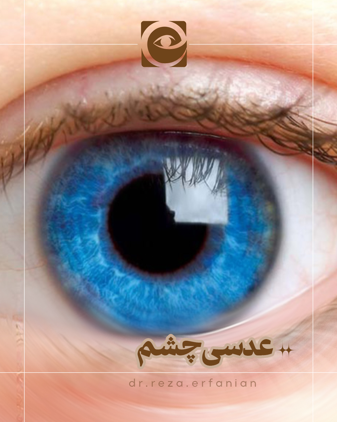 لنز چشم - همه چیز در مورد این قسمت از چشم! - دکتر رضا عرفانیان سلیم