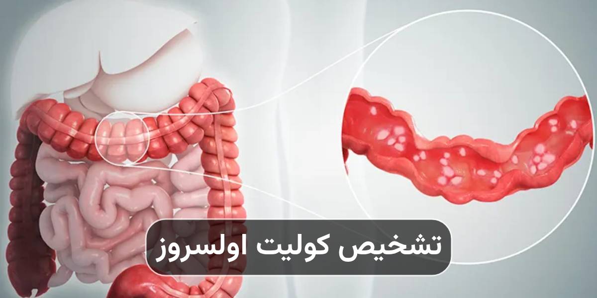 کولیت اولسراتیو چگونه تشخیص داده می شود؟ آزمایشات و کولونوسکوپی - کلینیک بیماریهای التهابی روده