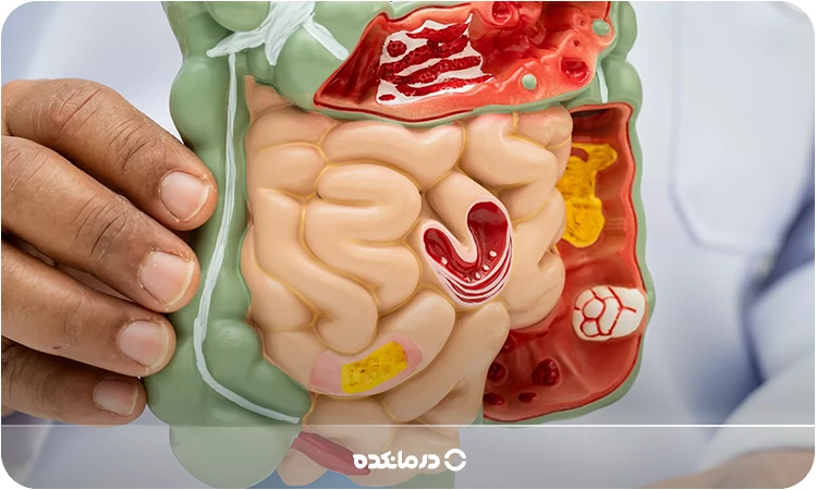 پیچ خوردگی روده یا ولولوس چیست؟ بررسی علائم و روش های درمان